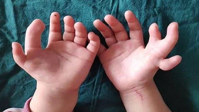 طفلة صينية ولدت بـ 14 إصبعاً في اليدين